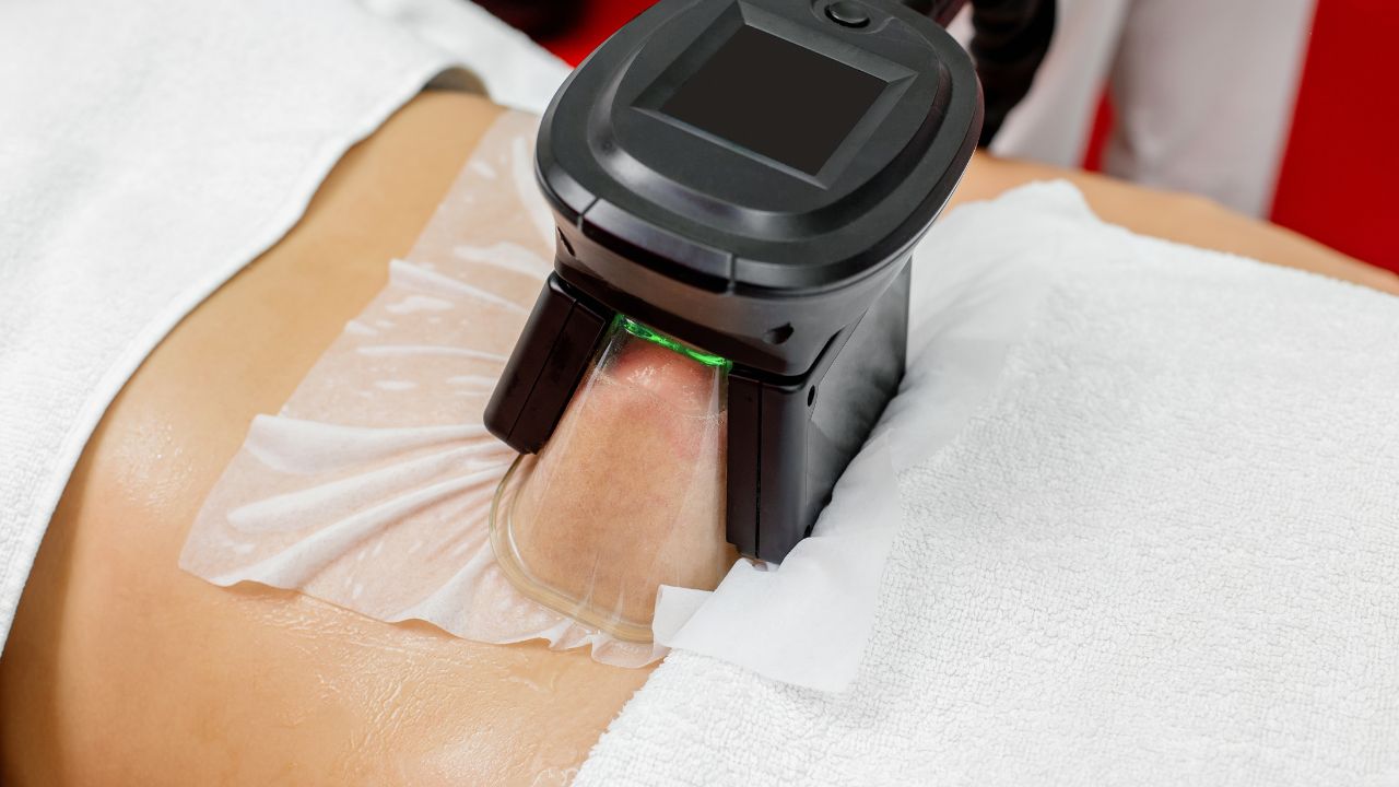 Kriolipoliza - Innowacyjny sposób na modelowanie sylwetki