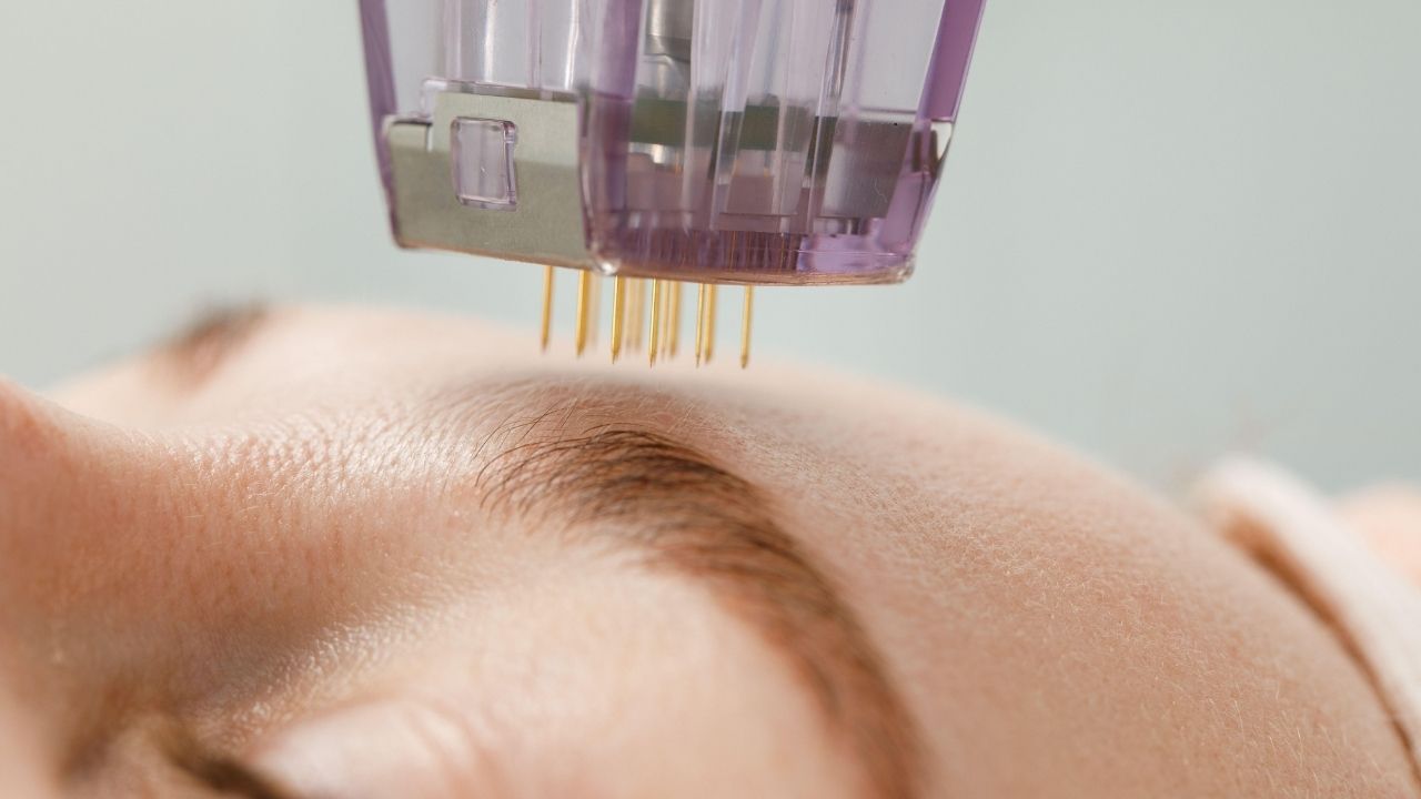 Mezoterapia mikroigłowa – czy jest mniej bolesna i jakie daje rezultaty?