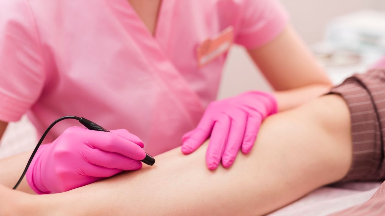 Laserowe zamykanie naczynek – jak działa